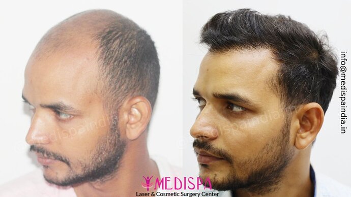 Dr. Suneet Soni - 5294 Grafts, Combine FUT + FUE + Beard Technique, NW- VI, 2 Years Result photo