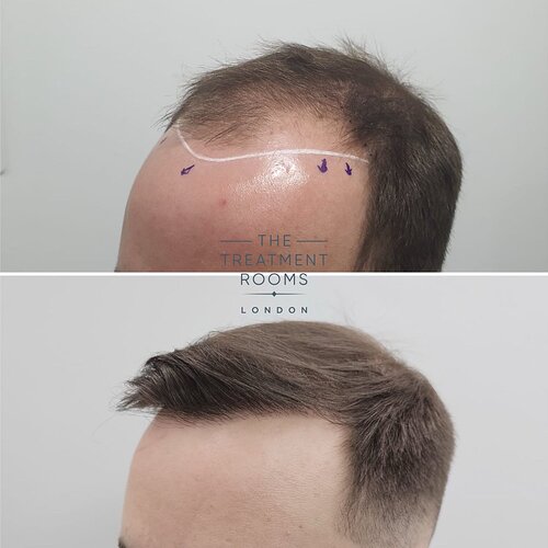 Result- Frontal Third FUE Hair Transplant- 2187 Grafts photo