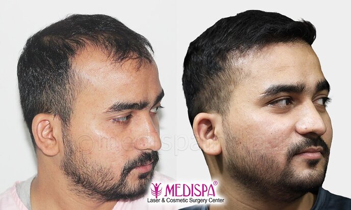 Dr. Suneet Soni - 4500 Grafts, Combine FUT + FUE + Beard Technique , NW- IV photo