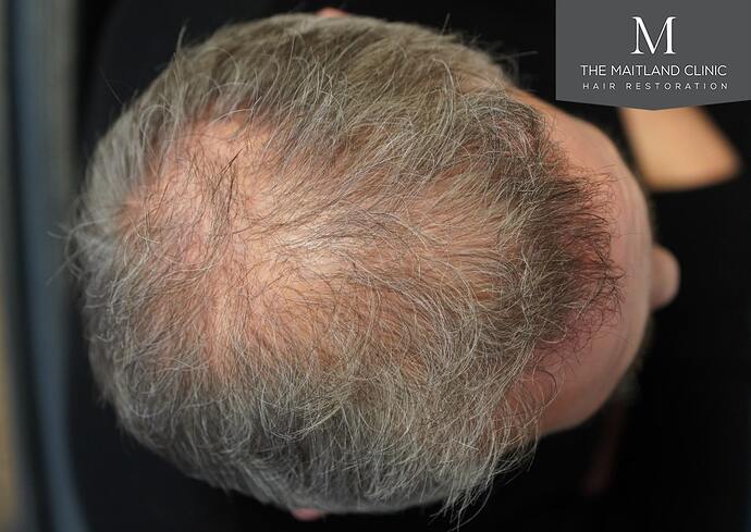 Dr Ball - The Maitland Clinic 2448 Grafts By FUT photo