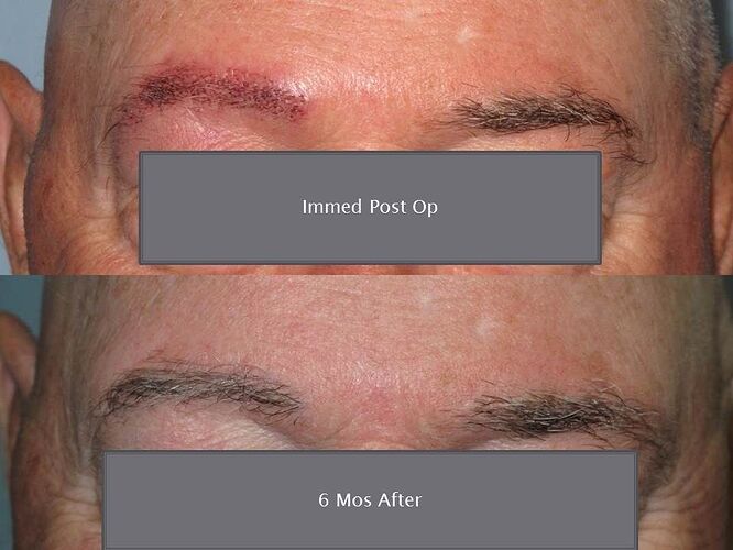 Dr. Ron Shapiro-Eyebrow restoration –6 Month’s FUE Result 236gr/383 hairs photo
