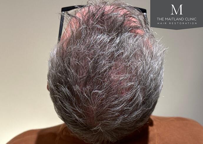 Dr Ball - The Maitland Clinic 2448 Grafts By FUT photo