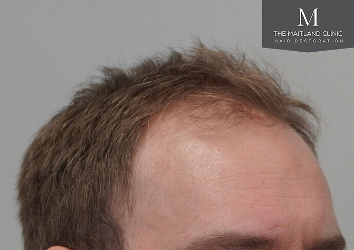 1826 grafts by FUE with Dr Edward Maitland Ball at The Maitland Clinic photo