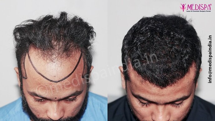 Dr. Suneet Soni - 5320 Grafts, Combine FUT + FUE Technique , NW- IV photo