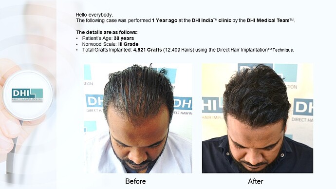 DHI India™ | NW 3 | 4,821 Grafts | 1 year DHI Hair Transplant Results photo