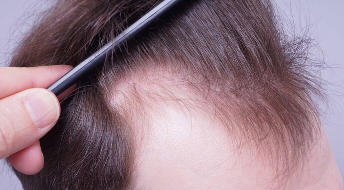 Dr B Farjo 1560g FUE (Frontal) photo