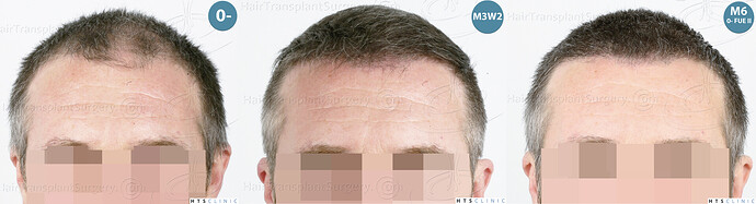 Dr. Jean Devroye, HTS Clinic / 5913 grafts (3036 FUE + 2877 FUE-BHT) / 2 sessions photo