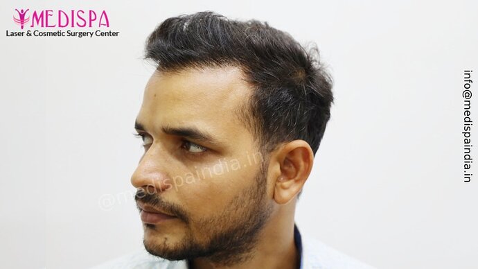 Dr. Suneet Soni - 5294 Grafts, Combine FUT + FUE + Beard Technique, NW- VI, 2 Years Result photo