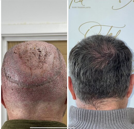 Dr Ted Miln (UK) | 6,120 grafts | FUT+FUE combo | Hairline, midscalp & crown restoration | 8.5 months post-op photo
