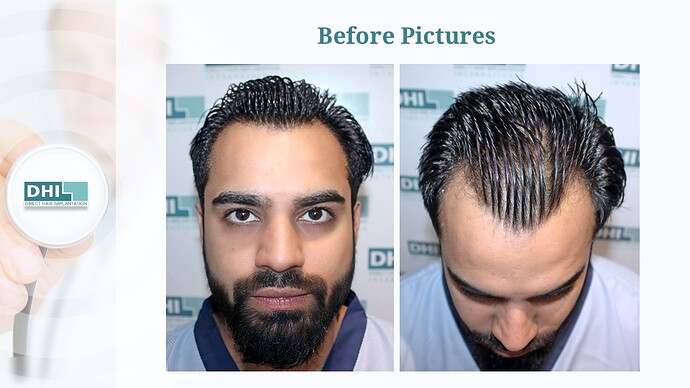 DHI India™ | NW 3 | 1,524 Grafts | Youthful Hairline Restored | DHI Hair Transplant photo