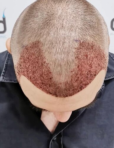 DR HAKAN DOGANAY/ 3600 GRAFTS / Implanter Pen+FUE photo