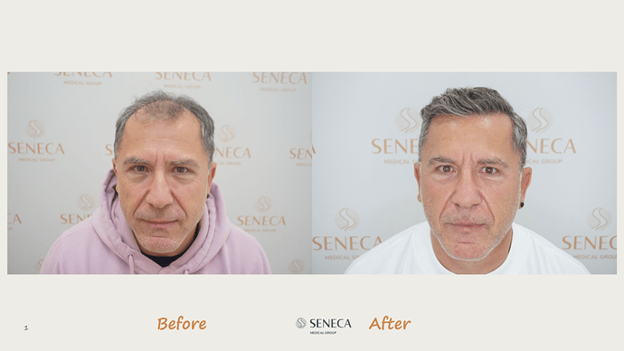 Seneca Medical Group - 3000 grafts with Direct Fue photo