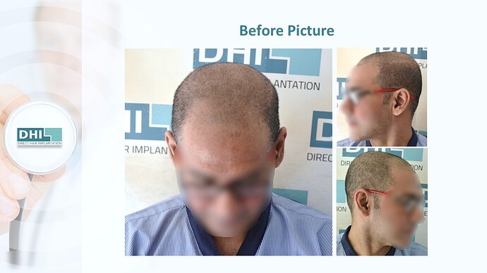 DHI India™ | NW 4 | 3,759 Grafts | 1 year DHI Hair Transplant Results photo