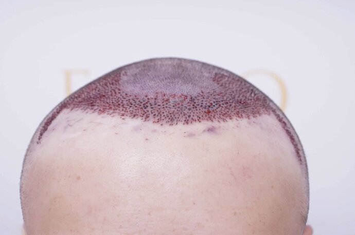 Dr Bessam Farjo FUE 1720 grafts to frontal recessions photo