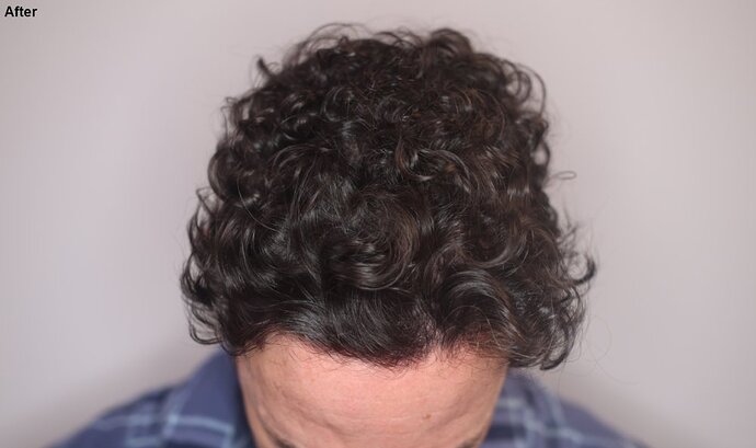 Dr. Ischayek hair restoration result - 1,075 grafts alviarmani photo