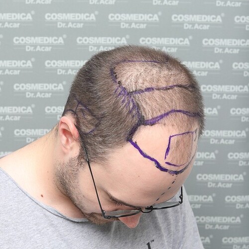 Cosmedica - 4000 Graft FUE Hair Transplant with Sapphire Blades. photo