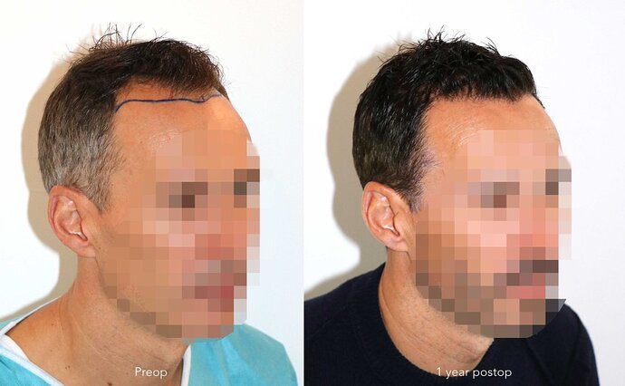 Case performed by Dr. Feriduni – 3095 FU in 1 procedure photo