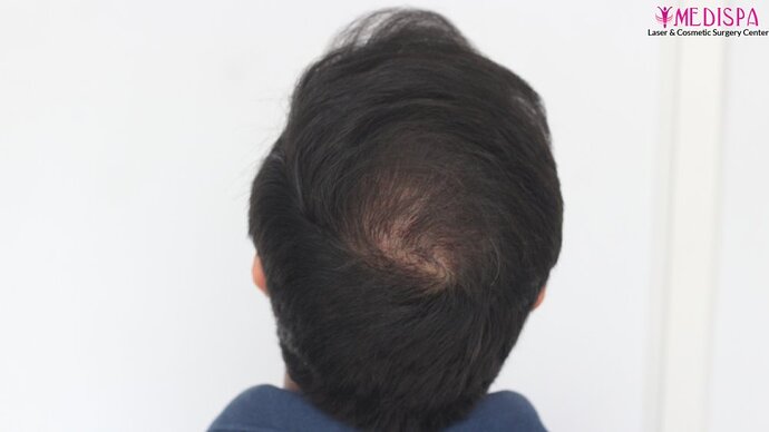 Dr. Suneet Soni - 4937 Grafts, Combine FUT + FUE Technique, NW : IV-V photo