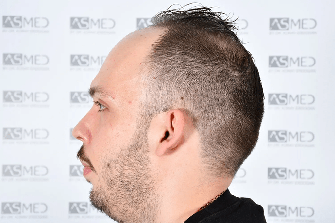ASMED, Istanbul: 5,071 Manual FUE Grafts 0/12 Months photo