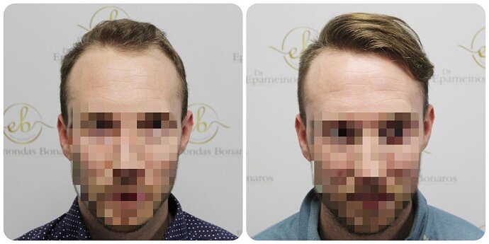 Dr Bonaros, Glasgow, UK / 1819 FUE grafts / 0-12 Months photo