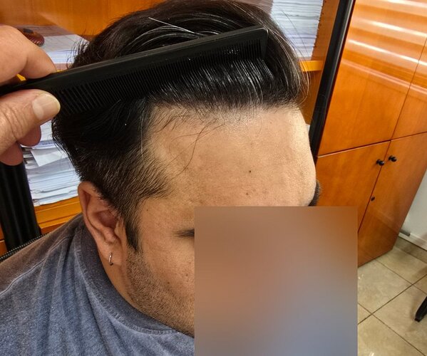 Density Enhancement Result for 4516 FUE Grafts – HDC Hair Clinic – 1 Year Post-Procedure photo