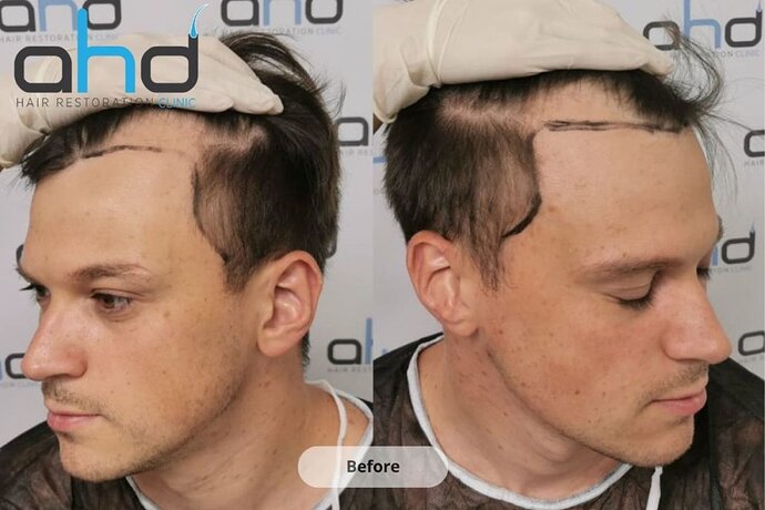 AHD Clinic / Technicians / 2250 grafts / FUE + DHI photo