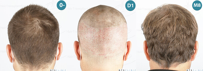 Dr. Jean Devroye, HTS Clinic / 2007 FUE / Hairline and frontal area restoration photo