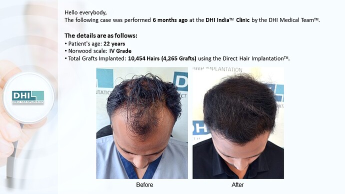 DHI India™ | NW 4 | 4,265 Grafts | 6-Months DHI™ Hair Transplant Results photo