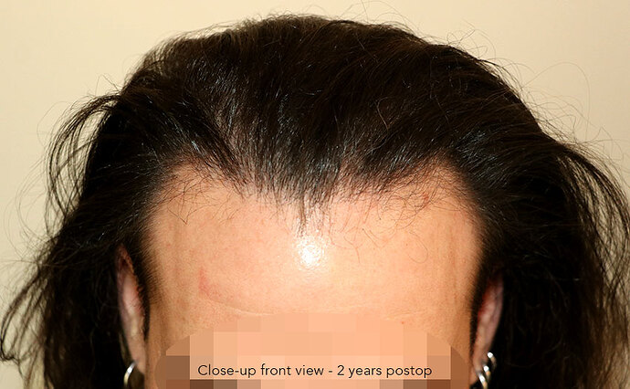 Case performed by Dr. Feriduni – 3346 FU in 1 procedure photo