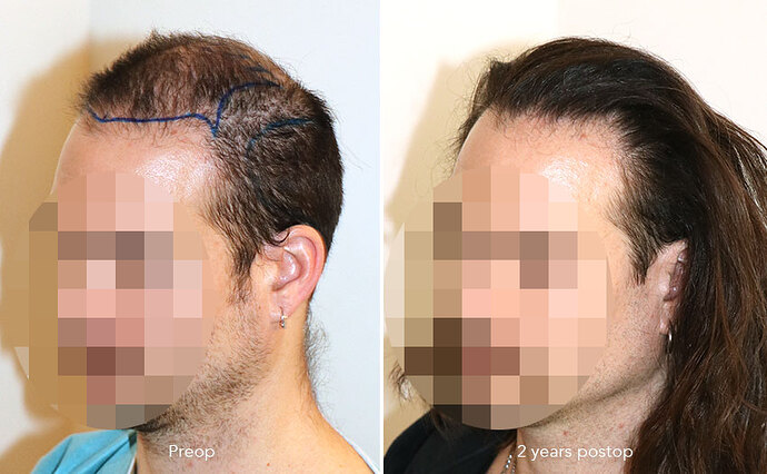 Case performed by Dr. Feriduni – 3346 FU in 1 procedure photo