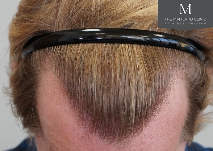 Dr. Ball The Maitland Clinic 1800 Graft FUE Hair Transplant photo