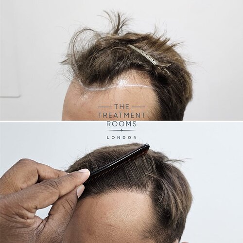 1332 Grafts Hairline Transplant Result photo