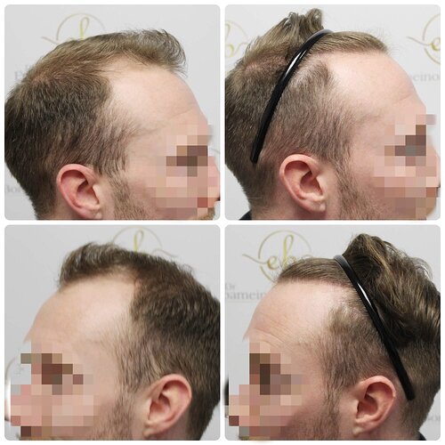 Dr Bonaros, Glasgow, UK / 1819 FUE grafts / 0-12 Months photo