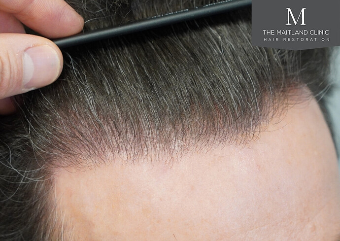 Before and after results: 1694 grafts by FUE at The Maitland Clinic (Dr Edward Maitland Ball) photo