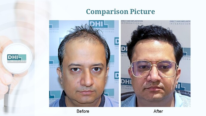 DHI India™ | NW 5 | 3,323 Grafts | 1 Year Hair Transplant Result photo