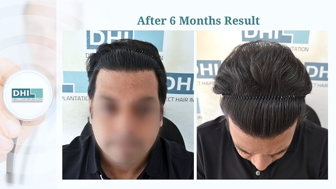 DHI India™ | 4,133 Grafts | Diffuse Alopecia | Full Coverage in 6 Months photo