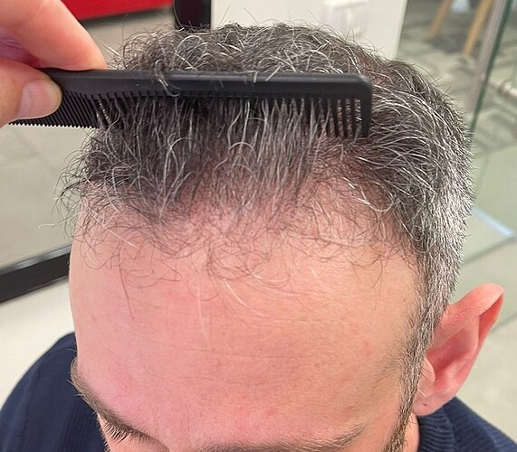 Result of Class 3V Patient – 3530 Grafts – HDC Hair clinic – Dr Maras photo