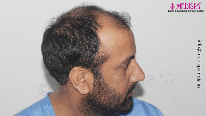 Dr. Suneet Soni - 5334 Grafts, Combine FUT + FUE + BHT (Beard) Technique, NW- V photo