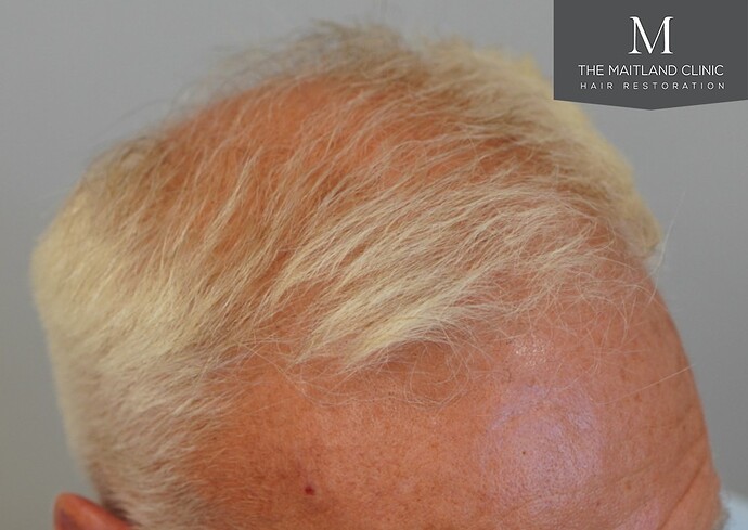 Dr Ball - The Maitland Clinic 2280 Grafts by FUE photo