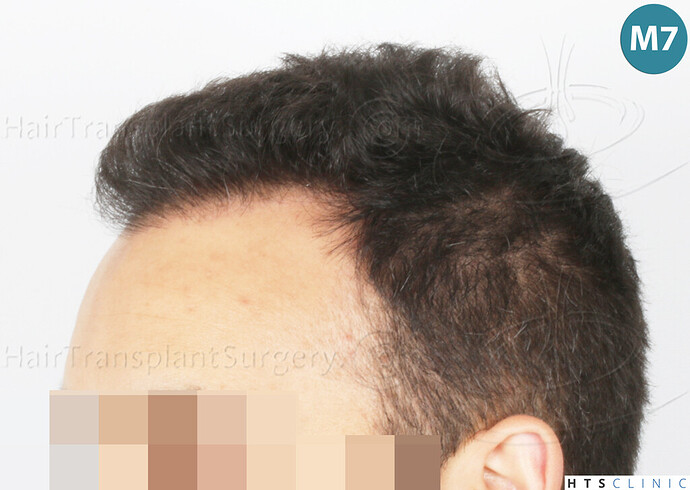 Dr Devroye + Dr Montesanti + Dr Jenard, HTS Clinic / 2018 FUE / Hairline & frontal area photo