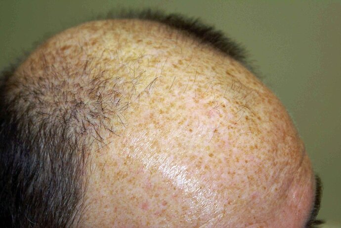 Dr B Farjo 2000-2023 Patient using both FUT and FUE, photo