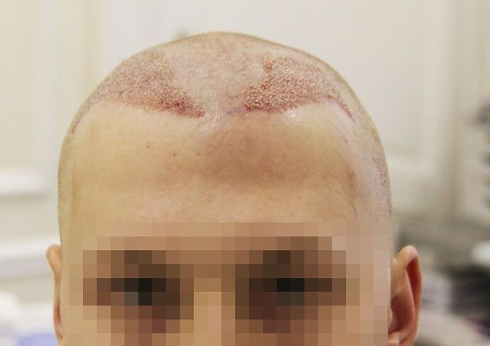 Dr. Bisanga, BHR Clinic, 1819 FUE / 0-10 Months photo