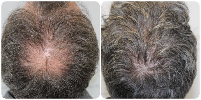 Dr Bonaros, Glasgow, UK / 3595 FUE grafts / 0-12 Months photo