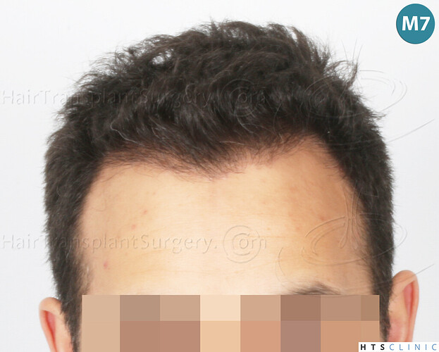 Dr Devroye + Dr Montesanti + Dr Jenard, HTS Clinic / 2018 FUE / Hairline & frontal area photo