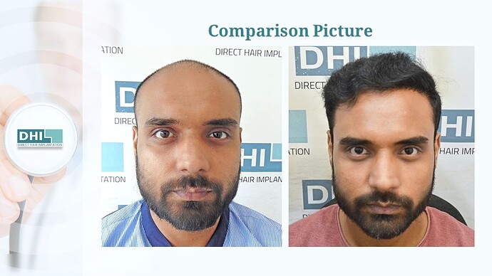 DHI India™ | NW 6 | 4,473 Grafts | 1-Year Hair Transplant Result photo