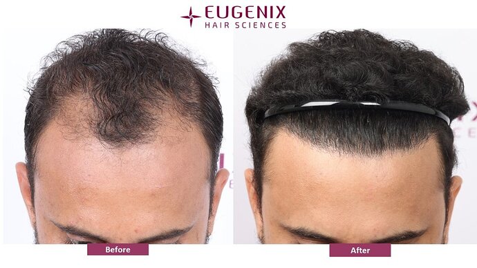 Eugenix Hair Sciences Clinic | Norwood Grade 3 | 22 Months Hair Transplant Results| photo