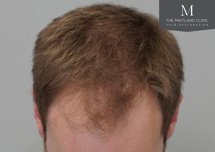 1826 grafts by FUE with Dr Edward Maitland Ball at The Maitland Clinic photo