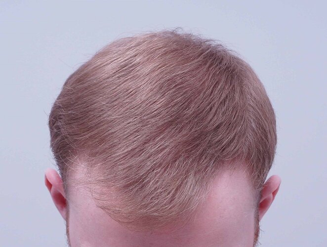 Dr B Farjo 1820 FUE (Fontal) Very early growth. photo