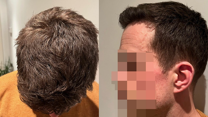 Dr. Bisanga & Dr. Kostis 2180 FUE 0 - 6 MONTHS - FAST AND NATURAL GROWTH! photo