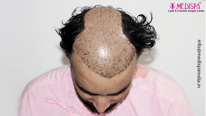 Dr. Suneet Soni - 4046 Grafts | 12-Month Result | Combination FUT + FUE + Beard photo
